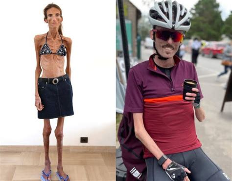 the world's skinniest person|the skinniest person on earth.